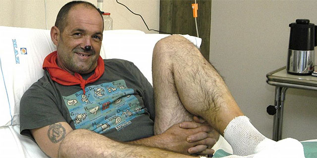 Oiarzabal in a hospital bed with bandaged feet after amputations and a black nose tip.